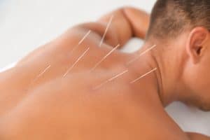Acupuncture Broward County, Fl