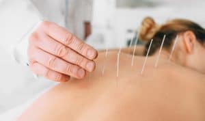 Acupuncture Broward County