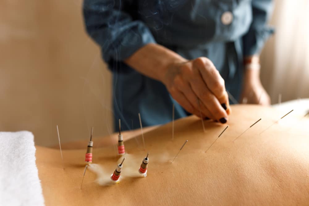 Advanced Acupuncture Broward County