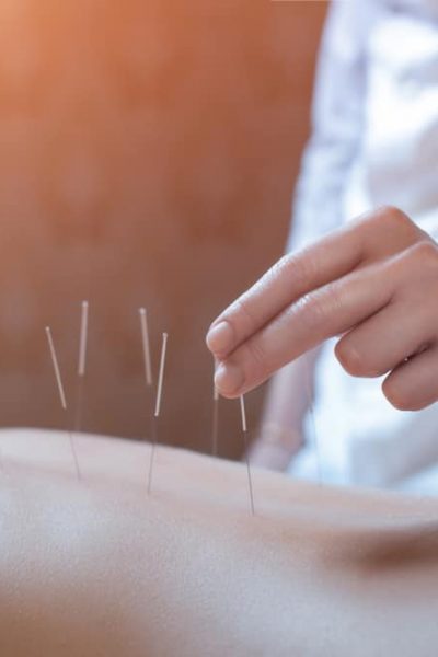 Acupuncture Broward County, Fl