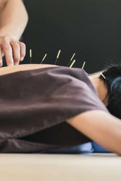 Acupuncture Broward County